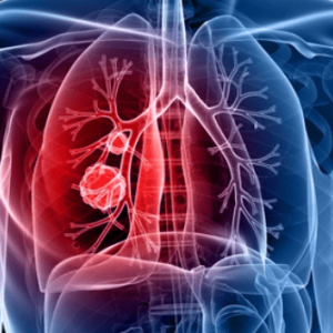 Рак на белия дроб | Anadolu Medical Center