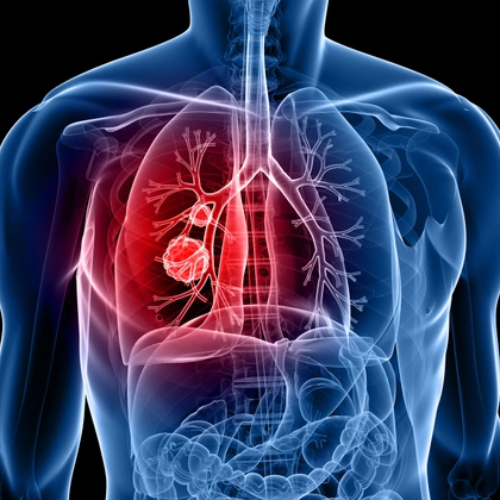 Рак на белия дроб | Anadolu Medical Center
